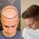 The Positive Effects of Hair Transplant in Your Life