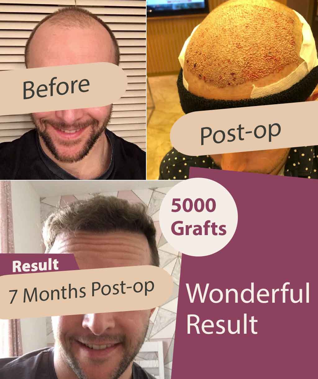 Hair Transplant Before and After – 5000 Grafts